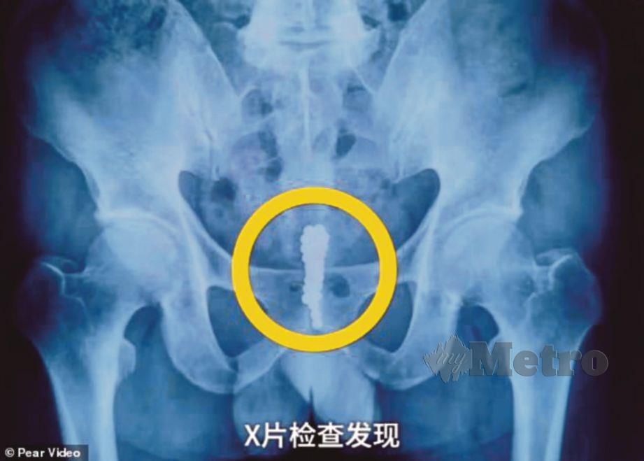 GAMBAR X-ray menunjukkan bebola magnet yang berkumpul di pundi kencing lelaki itu. FOTO AGENSI