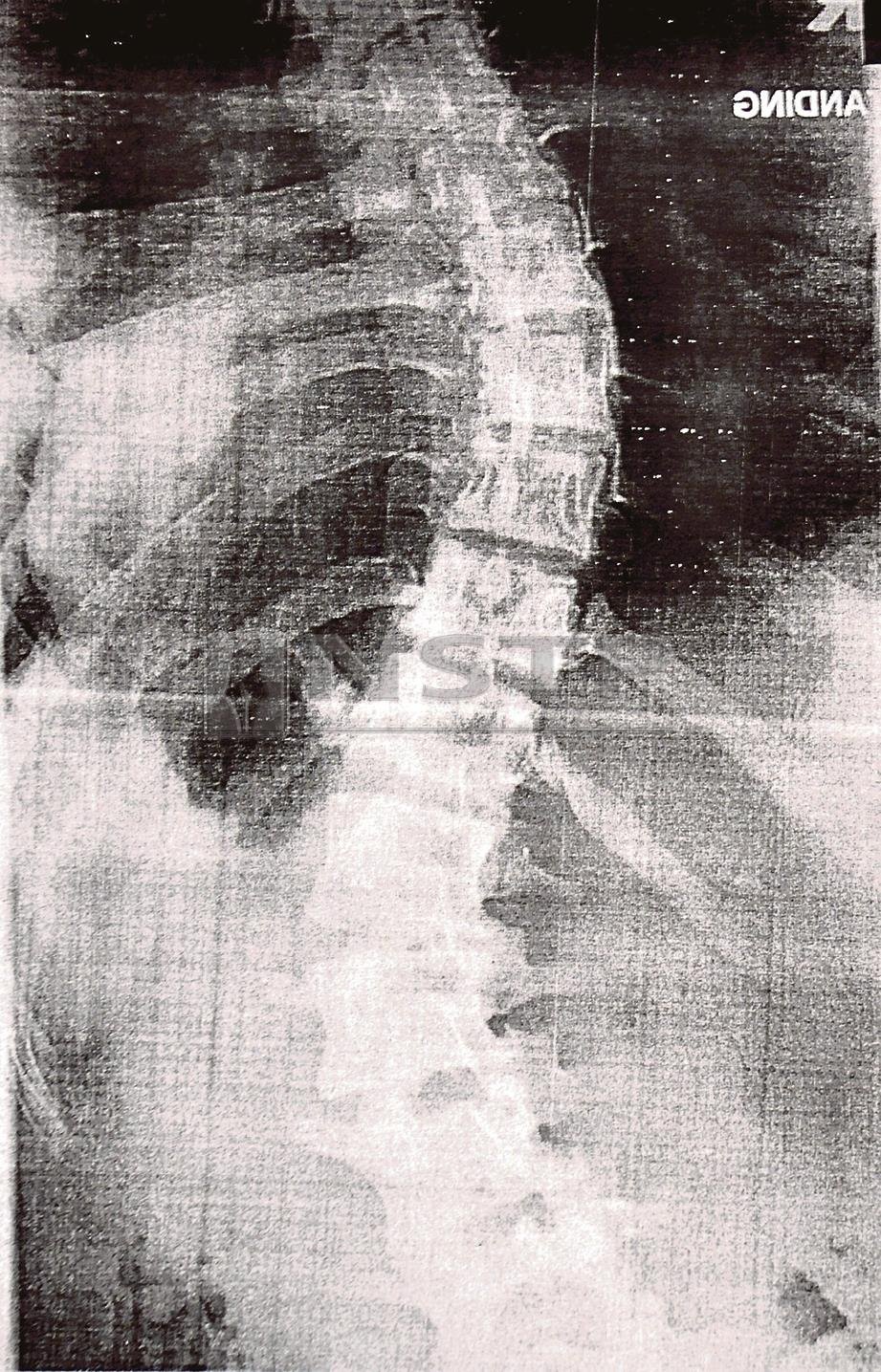 IMBASAN x-ray keadaan tulang belakang milik Aida Natasha Abdullah, 16, akibat menderita penyakit tulang belakang bengkok atau dikenali sebagai Adoloscent Idiopathic Scoliosis sejak awal Mac lalu ketika ditemui di Bangunan Kota Cemerlang, Ayer Keroh.  