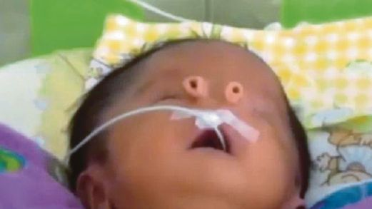 KEADAAN Angelito yang dilahirkan dengan dua lubang hidung yang terkeluar dari mukanya.