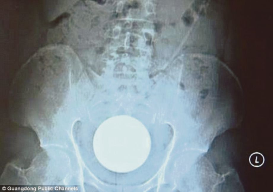 GAMBAR X-ray menunjukkan bebola kaca yang tersangkut di rektum lelaki itu. - Guangdong Public Channels