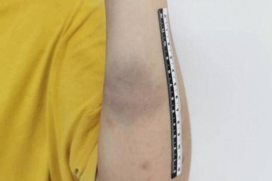 LIN cedera selepas dibelasah oleh ibunya dengan sebatang besi. FOTO: Agensi