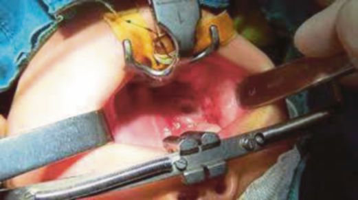 Letupan bateri itu menyebabkan lubang besar pada mulut Xuan Xuan.