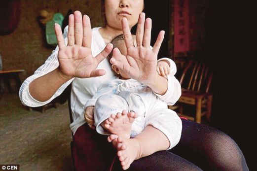 IBU Honghong turut menghidap keadaan sama. Honghong mempunyai lapan jari pada setiap kaki dan sebelah tangannya selain tujuh jari pada satu tangan.