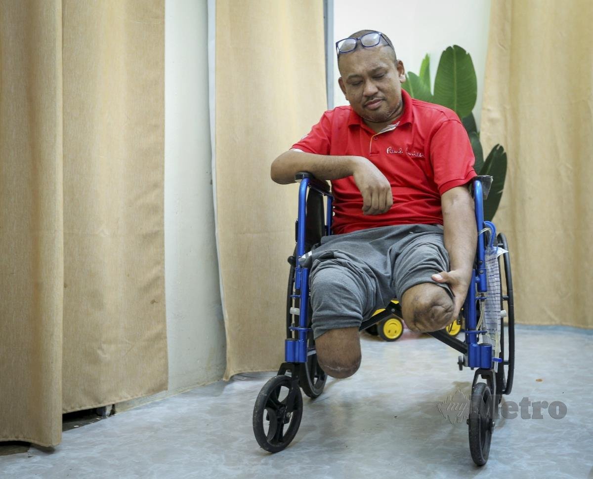 Alemi Abdul Manap, 40, menunjukkan kedua-dua belah kaki dipotong malah penglihatannya turut terjejas akibat penyakit kencing manis dan buah pinggang yang dihidapinya secara berperingkat sejak 2014, ketika ditemui di rumahnya di Taman Kelab Tuanku, Mambau. FOTO AZRUL EDHAM