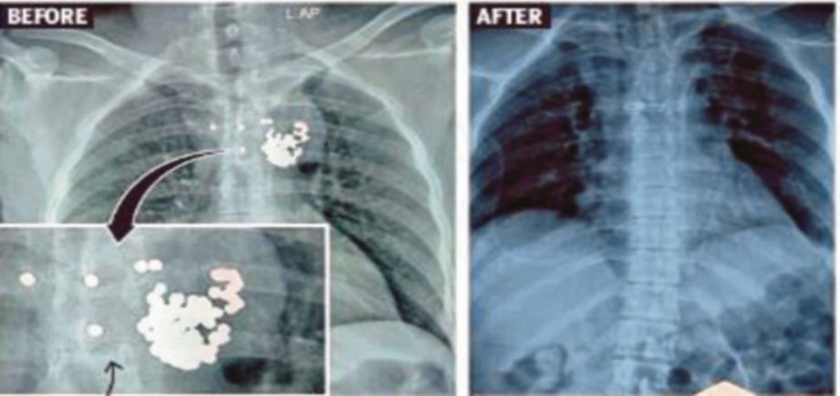 GAMBAR X-ray menunjukkan peluru penabur di dada Aarif (kiri) dan selepas ia dikeluarkan. - Agensi