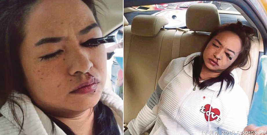 Keadaan pensil celak yang menusuk mata seorang wanita dalam teksi di Bangkok. - Agensi