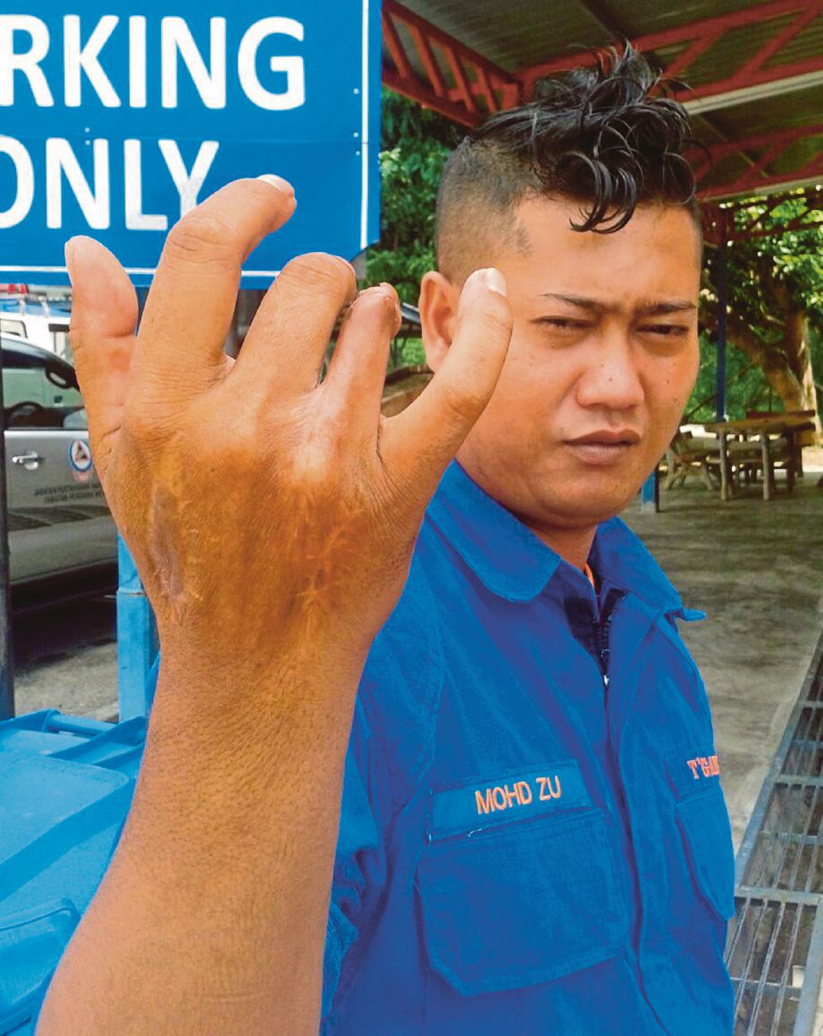 MOHD Zu menunjukkan tangan kanannya yang cacat akibat dipatuk ular tedung senduk pada 2010.