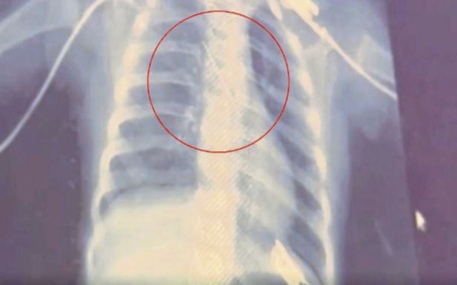 GAMBAR X-ray menunjukkan kedudukan jarum di dalam tekak kanak-kanak berkenaan. FOTO/AGENSI