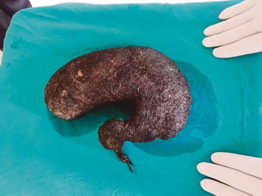 KEADAAN gumpalan rambut yang dikeluarkan dari perut seorang gadis di India baru-baru ini. - Agensi
