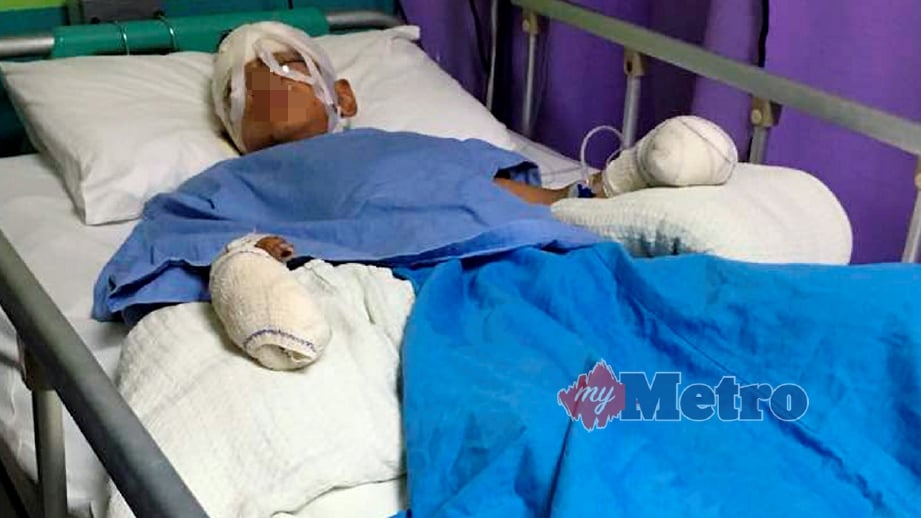 MANGSA mercun pertama di Kelantan buta mata kanan dan hancur enam jari selepas belerang mercun bola meletup atas bara. FOTO Siti Nor Hidayatidayu Razali