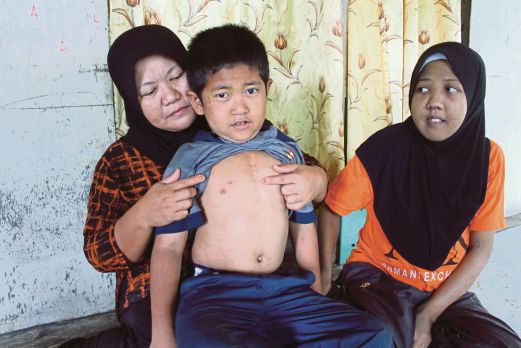 ZAITON menunjukkan kesan pembedahan pada dada Mohd Putraazamuddin sambil ditemani anak kedua, Nur Farah Idayu.