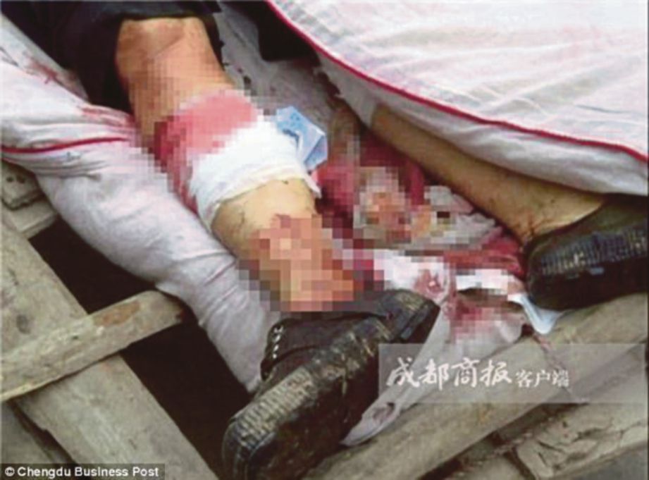  KEADAAN kaki Xu selepas suaminya secara tidak sengaja terpangkas kakinya menggunakan mesin pemotong rumput. - Agensi