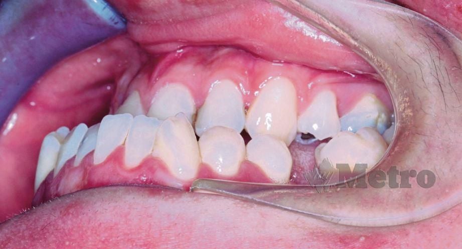 KEADAAN gigi yang memerlukan rawatan orthognatik. 