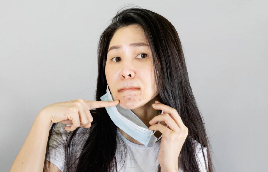 KESAN daripada pemakaian pelitup muka.  FOTO: Sumber Google
