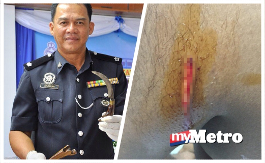 (KIRI) TIMBALAN Ketua Polis Daerah Kerian,Mohd Radzuan Bachik menunjukkan pisau kerambit. Lengan kiri anggota yang cedera. FOTO Shaiful Shahrin Ahmad Pauzi