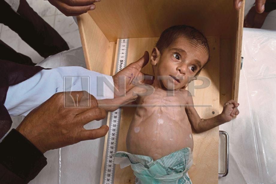 WADAH Askri Mesheel, 11 bulan, dirawat di sebuah klinik di Aslam, Yaman, minggu ini, mengalami kekurangan zat yang teruk. Bayi ini meninggal dunia lapan jam kemudian. - Agensi