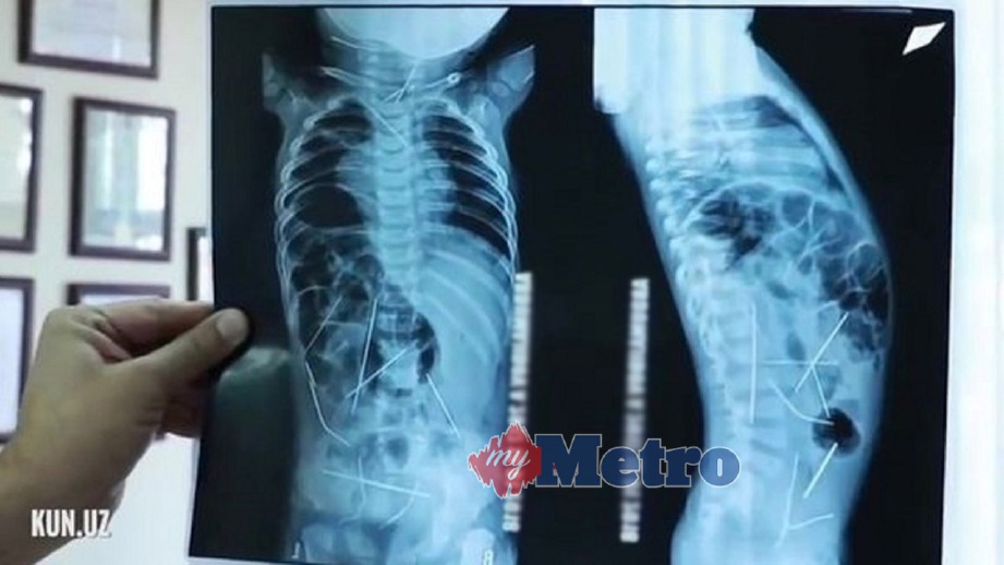 IMBASAN x-ray menunjukkan jarum di dalam badan bayi. FOTO Daily Mirror