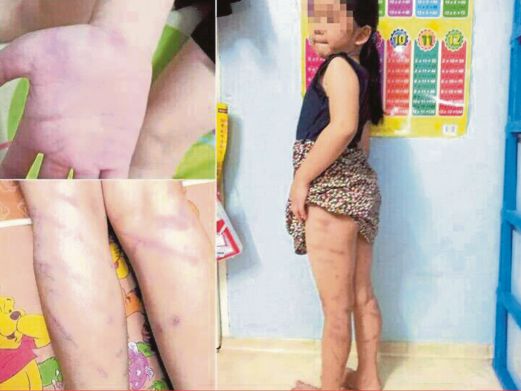 KEADAAN kanak-kanak yang cedera di seluruh badan disyaki dipukul guru tuisyen.  