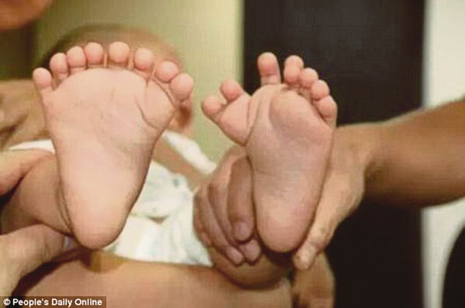 YUANYUAN  dilahirkan dengan 15 jari tangan dan 16 pada kakinya.