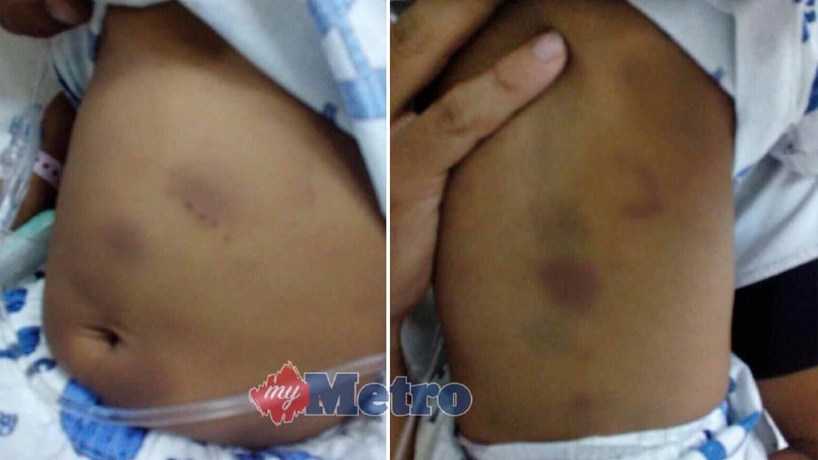 KESAN lebam dikesan pada perut dan belakang badan bayi perempuan berusia 10 bulan. FOTO ihsan Polis