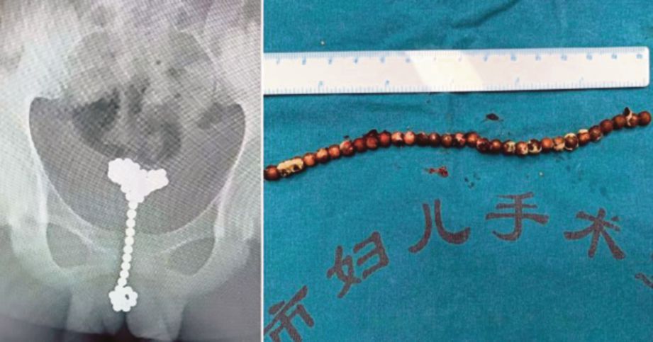 GAMBAR imbasan X-ray dan bebola magnet yang berjaya dikeluarkan dari pundi kencing budak lelaki itu. FOTO Agensi