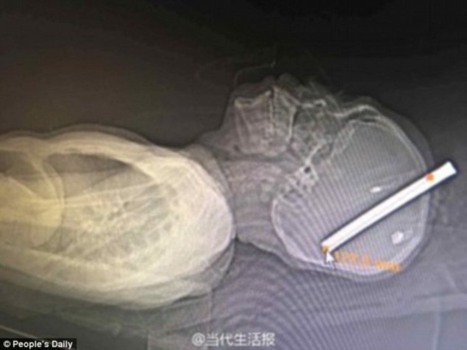 GAMBAR X-ray menunjukkan kedalaman paku yang menusuk otak Zhao. - Agensi