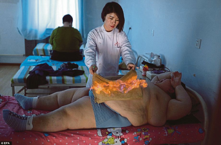GAMBAR atas, perawat membakar tuala pada perut Li Hang.