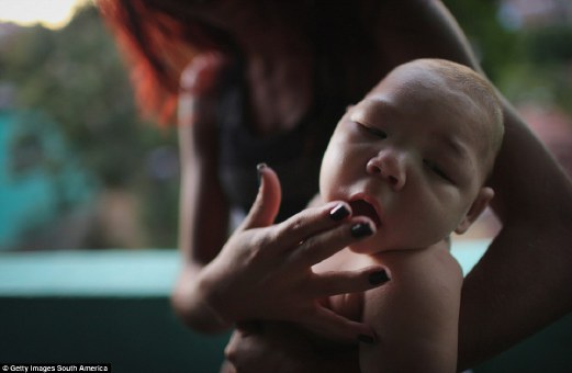 SEORANG bayi di Brazil yang menjadi mangsa virus zika.  