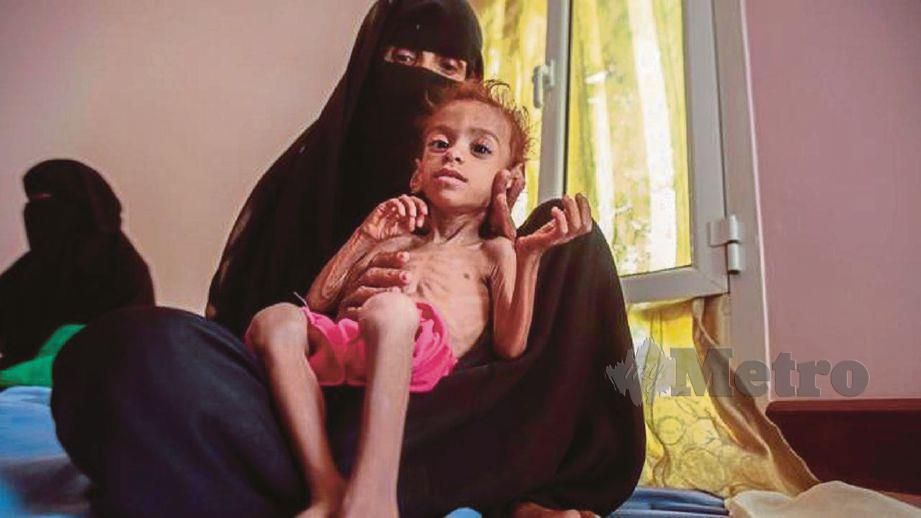 KANAK-KANAK Yaman yang kekurangan zat akibat kebuluran. - Agensi