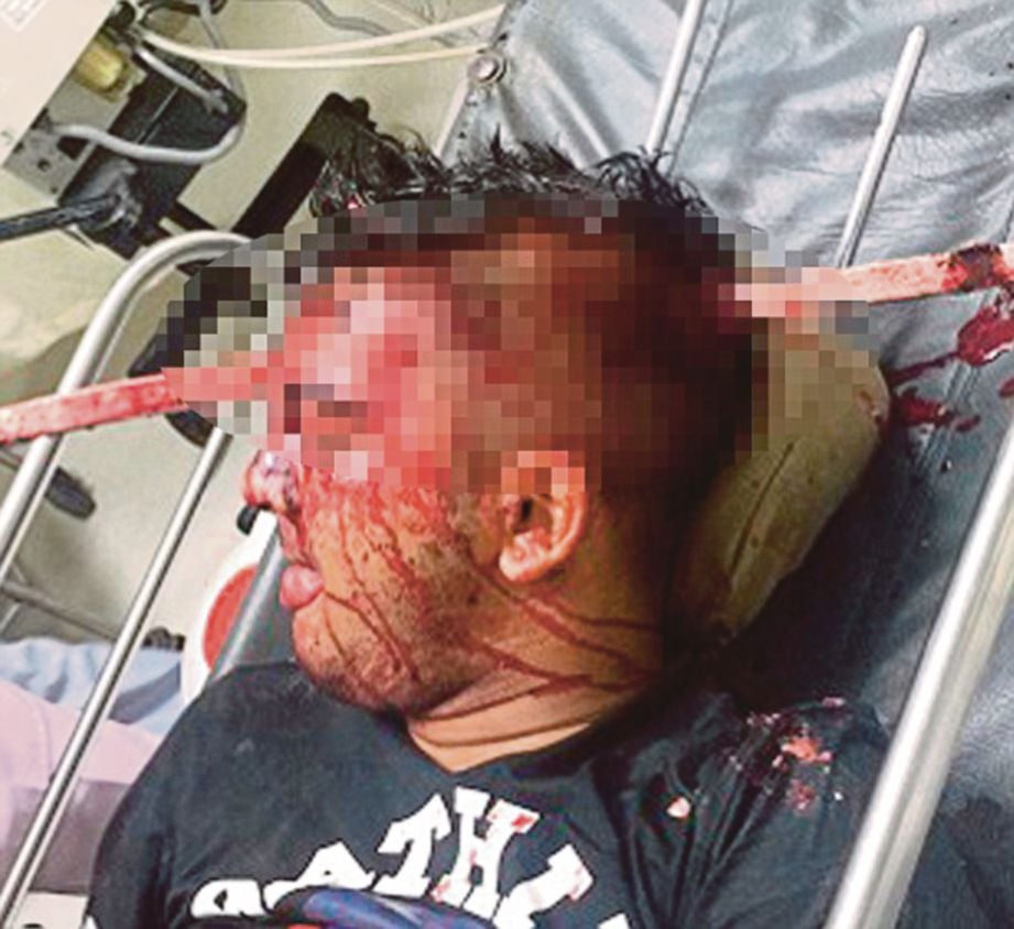 MOHAMMAD pada mulanya dijangka tidak dapat diselamatkan selepas dibawa ke hospital dengan besi menembusi kepala akibat terbabit dalam kemalangan. - Newslions Media