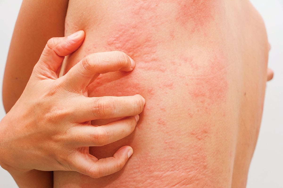 GEGATA menyebabkan bengkak kulit yang gatal. 