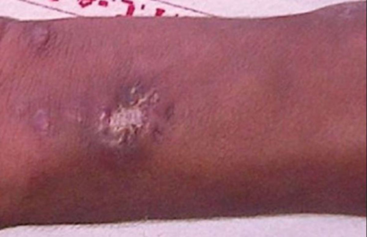 ULSER pada lengan remaja yang menyuntik merkuri. FOTO NCBI