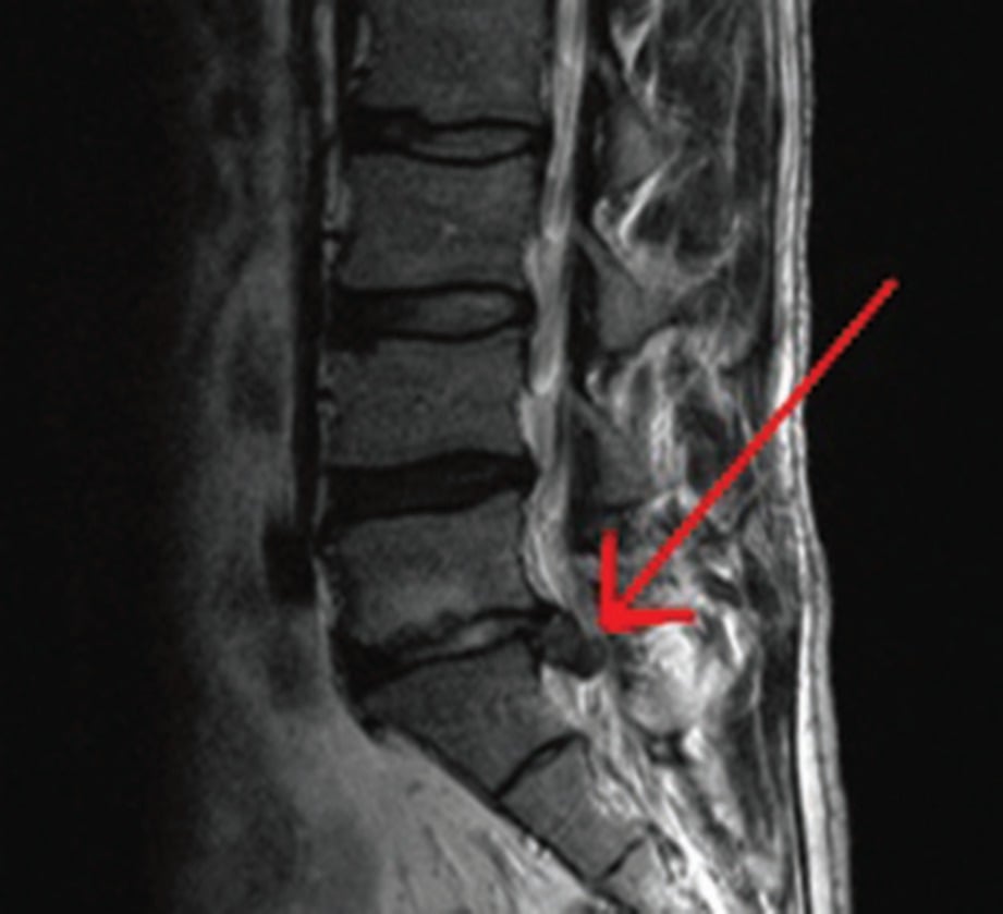 UJIAN imbasan MRI menunjukkan tulang lembut berwarna hitam terkeluar daripada kedudukan asal.  - FOTO Google