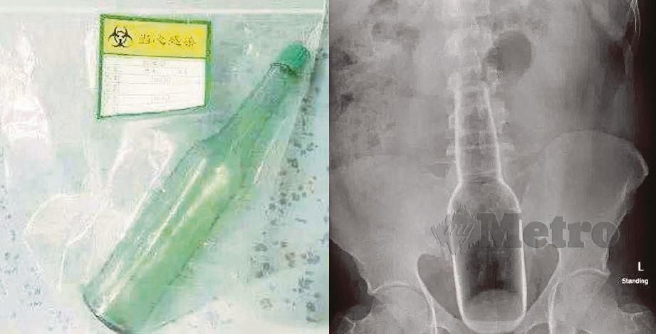 GAMBAR menunjukkan botol yang dikeluarkan dan imej X-ray yang memaparkan botol  di dalam perut lelaki berkenaan. - Agensi