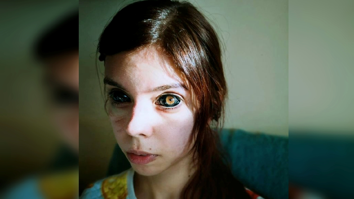 ALEKSANDRA menjalani tiga pembedahan namun tiada satu dapat memulihkan matanya. FOTO Agensi.