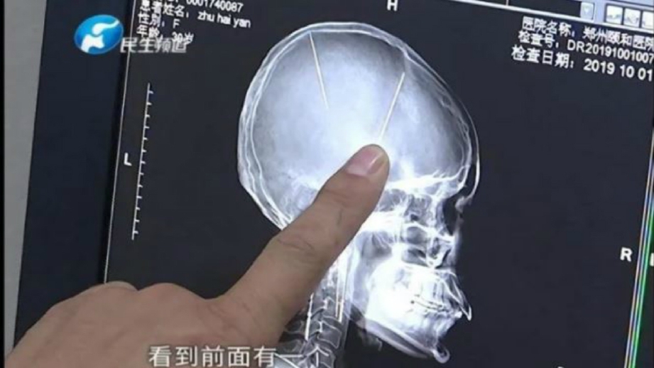 IMBASAN CT menunjukkan dua jarum tertanam dalam otak seorang wanita di China. FOTO Agensi