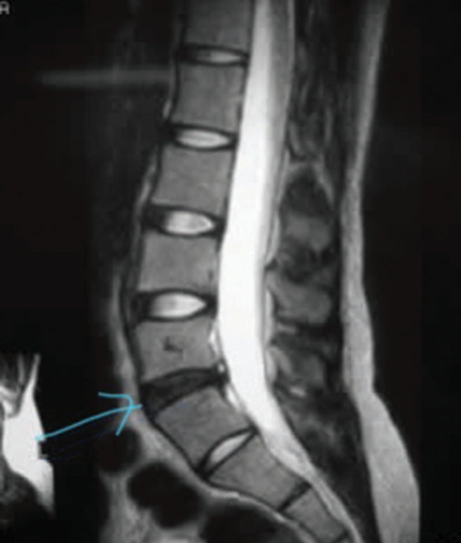 UJIAN imbasan MRI menunjukkan kemerosotan tulang.  - FOTO Google