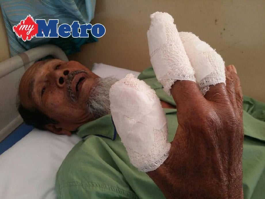 Awang cedera pada tiga jari tangan kanan selepas mercun bola yang digunakannya untuk menghalau tupai meletup di tangannya sebelum sempat dilempar, semalam. FOTO Khairul Hamizy Ramlee