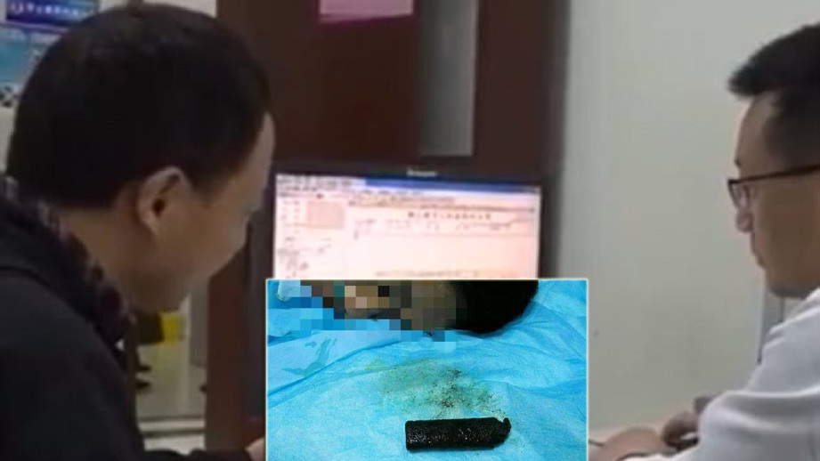 GAMBAR menunjukkan pemetik api dikeluarkan daripada dalam perut pesakit (kiri). - FOTO People’s Daily Online/Cover News/Jiangxi Network TV 