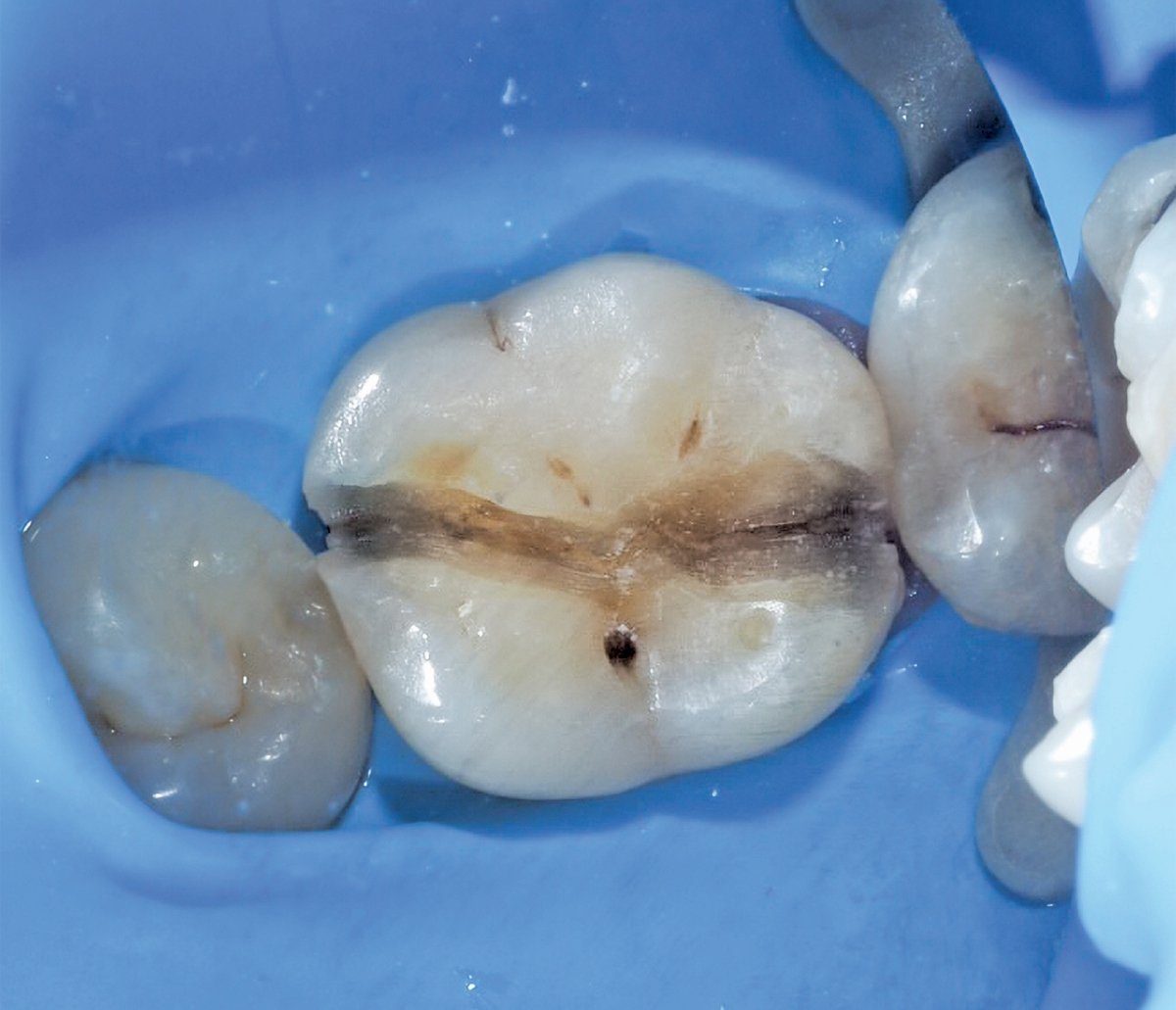 KEADAAN gigi retak setelah tampalan dibuang. - FOTO Google