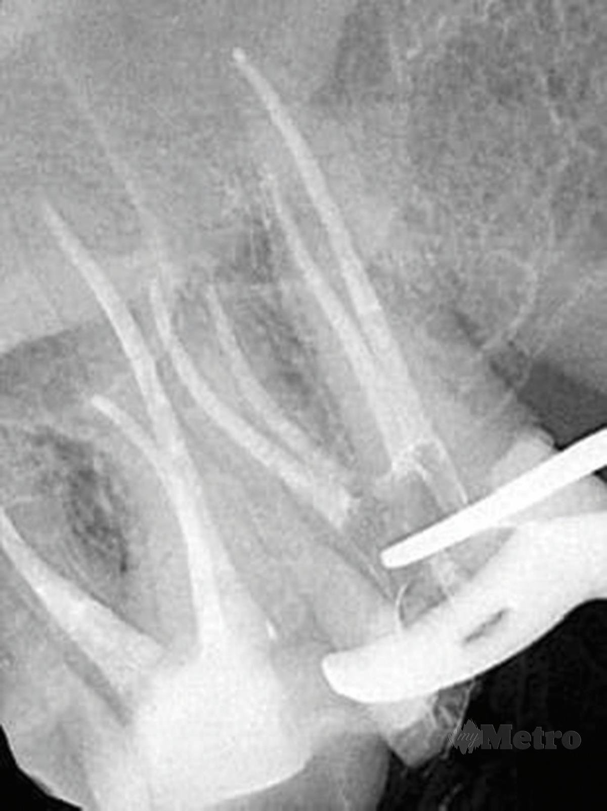 X-ray selepas rawatan akar.