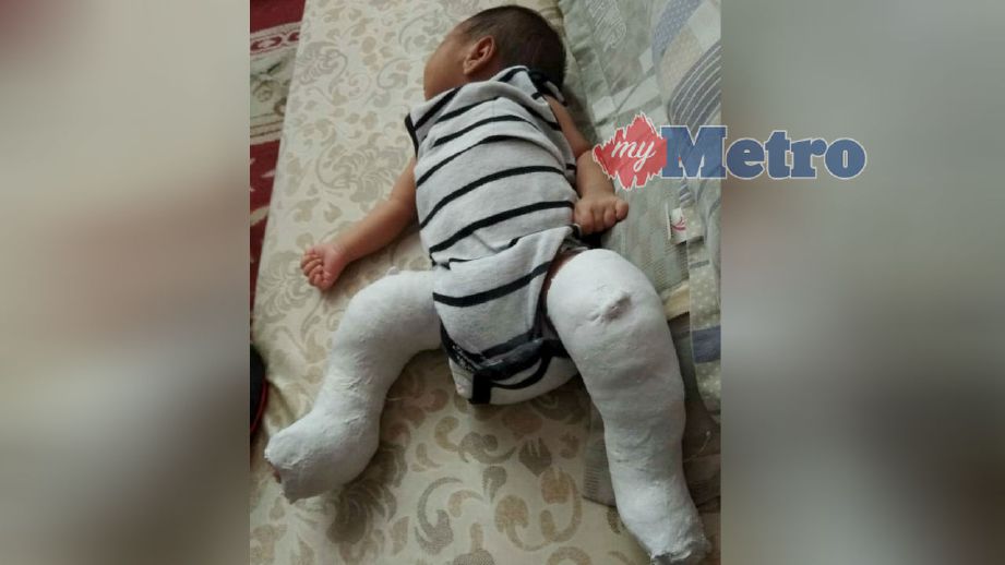 KEDUA-dua kaki Izzakif Aisy Iffat terpaksa disimen sejak berusia 21 hari dan setiap kali menjalani rawatan. Foto NSTP/MARY VICTORIA DASS