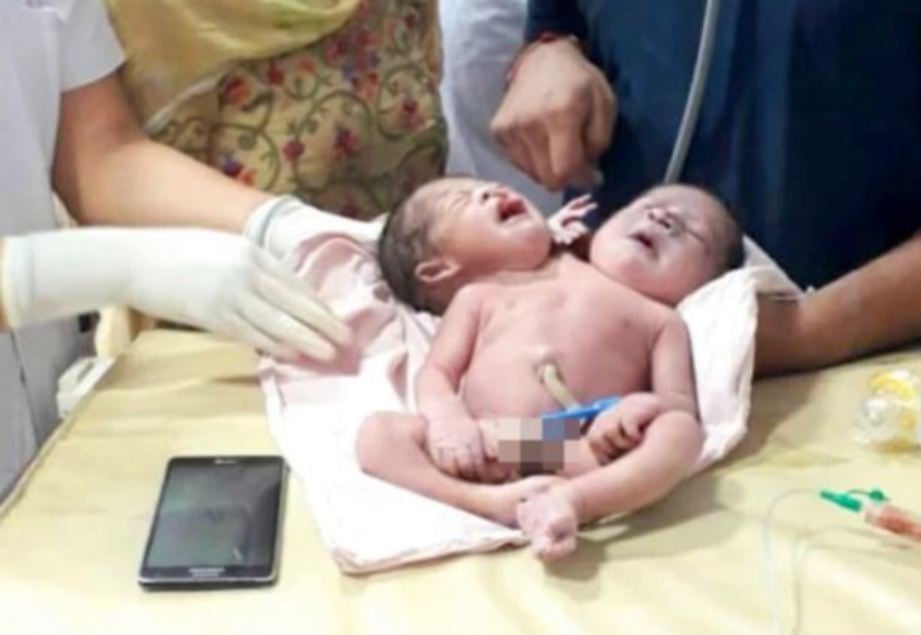 KEADAAN bayi kembar berkepala dua.
