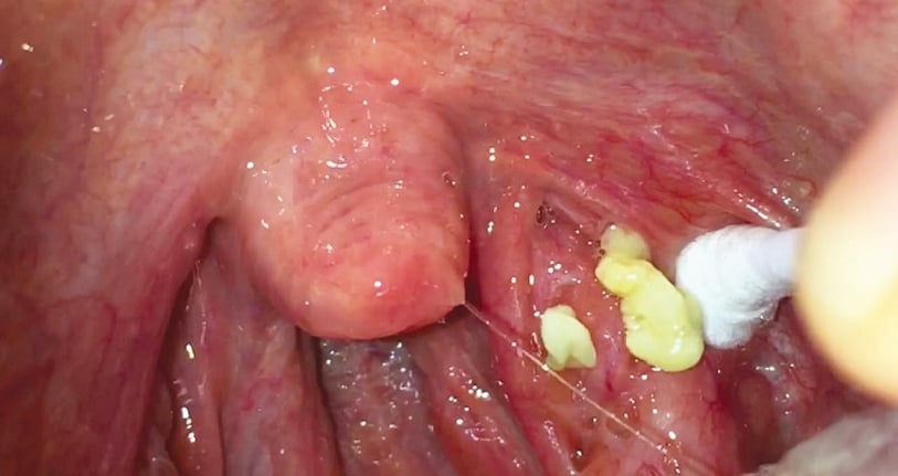 Cara merawat tonsil