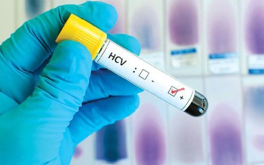 UJIAN darah perlu dilakukan terutama untuk golongan berisiko agar Hepatitis C dapat dikesan awal.