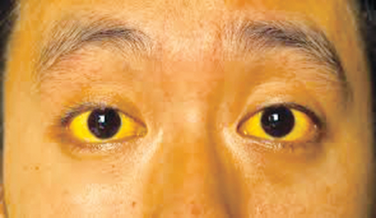 PERUBAHAN warna kekuningan pada mata adalah gejala hepatitis. 