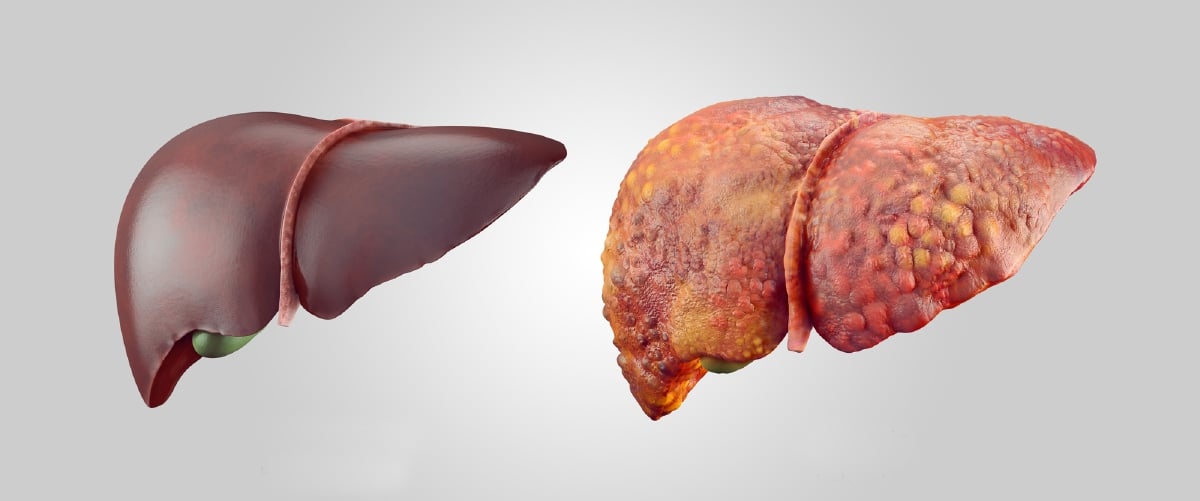 PERBANDINGAN hati sihat (kiri) dengan hati sirosis (kanan).