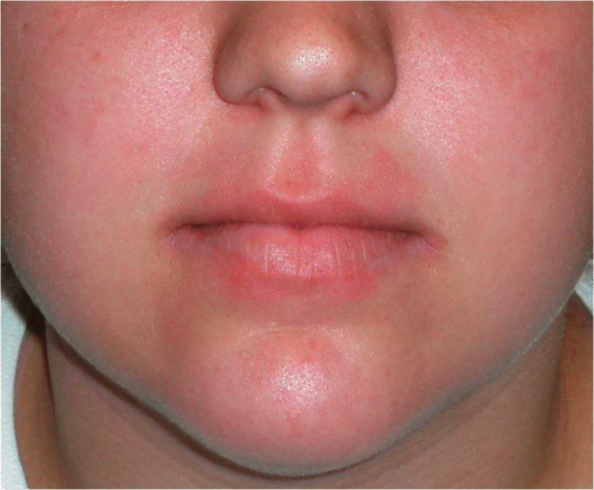RADANG kulit antara implikasi yang kerap boleh dilihat apabila adanya gejala kemerah-merahan.
