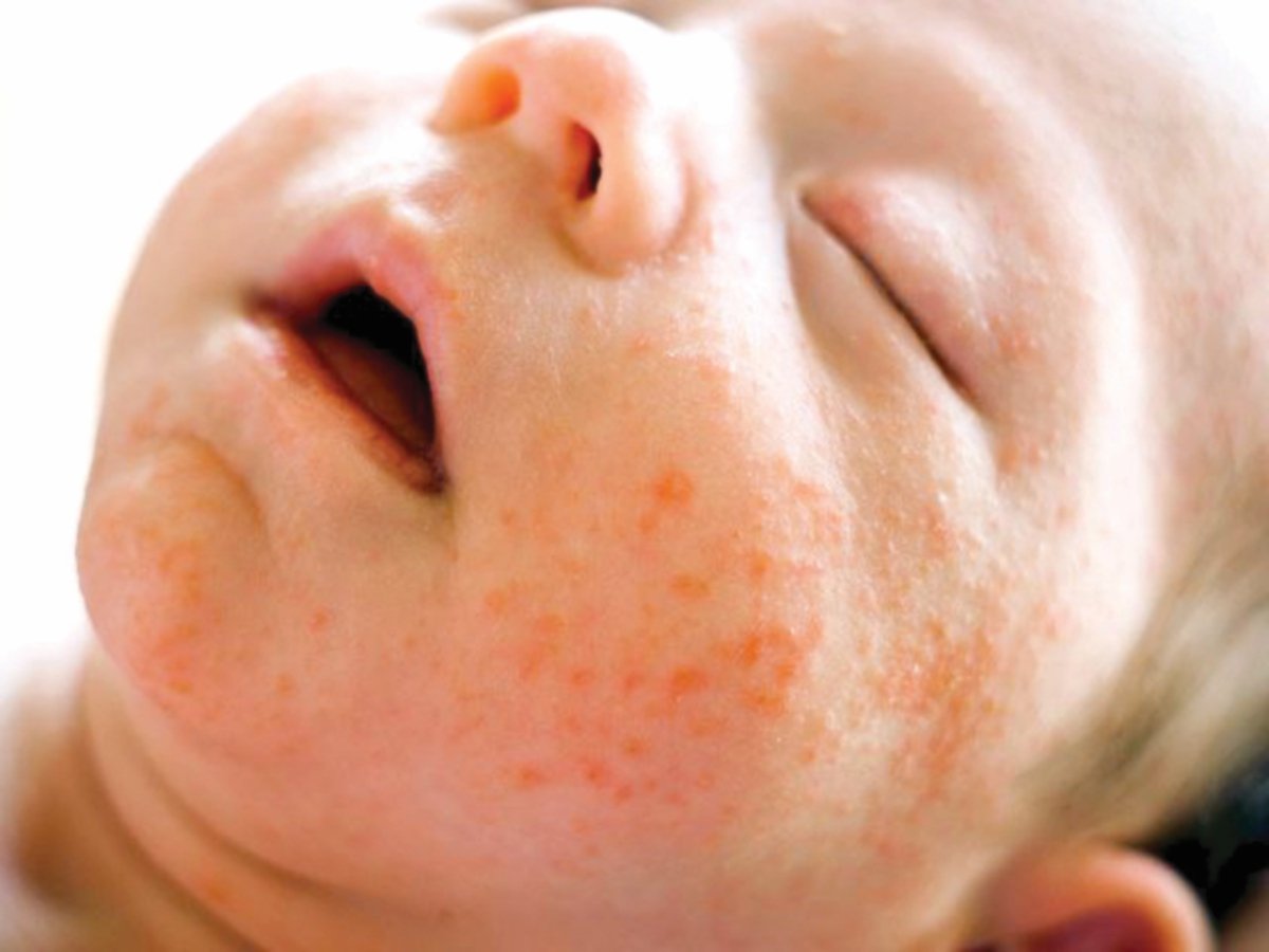 ANTARA jenis ruam yang biasa berlaku pada kulit bayi. 
