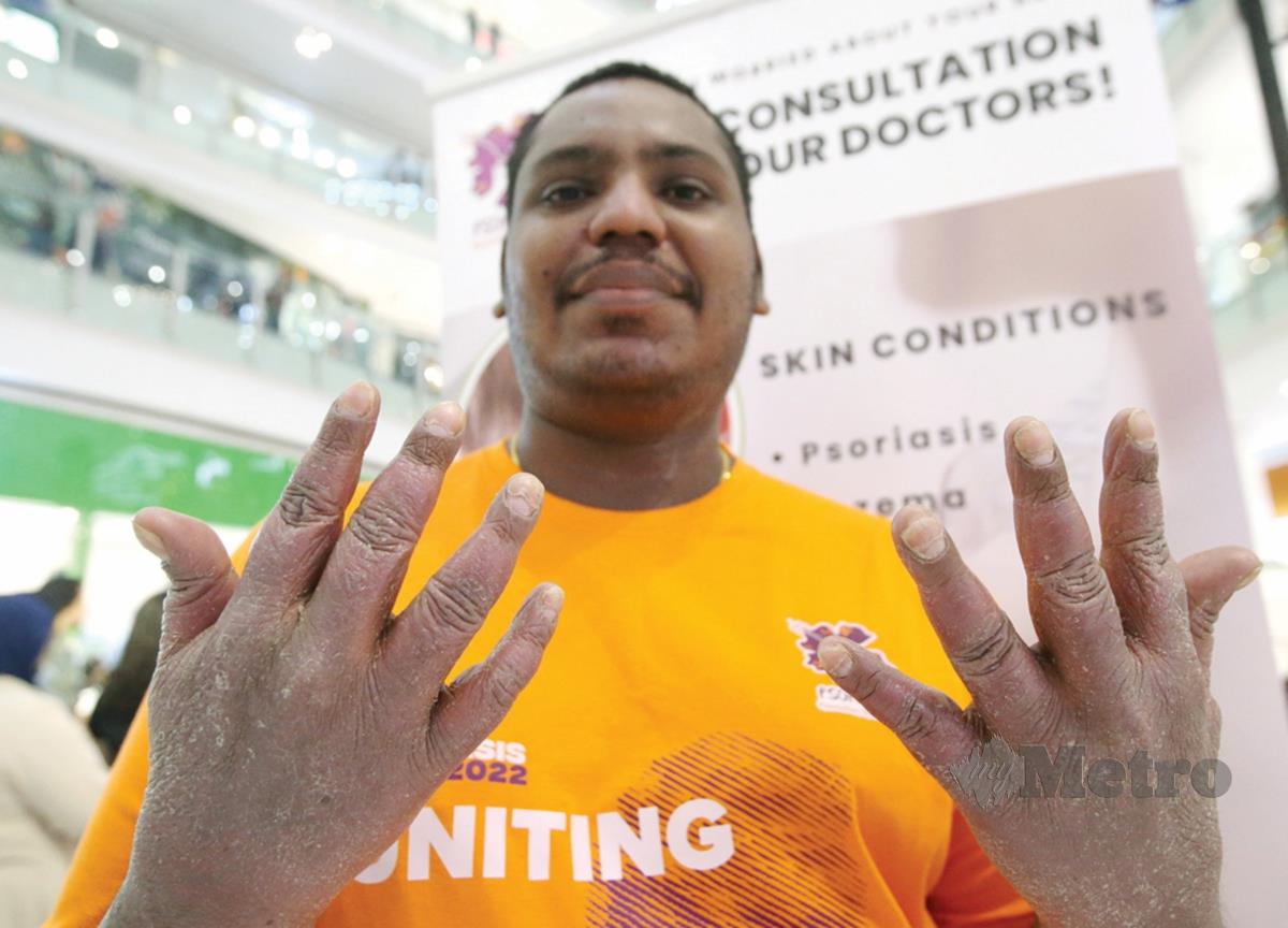 KUKU 10 jari tangan R Ananthan pernah enam kali tertanggal akibat psoriasis.